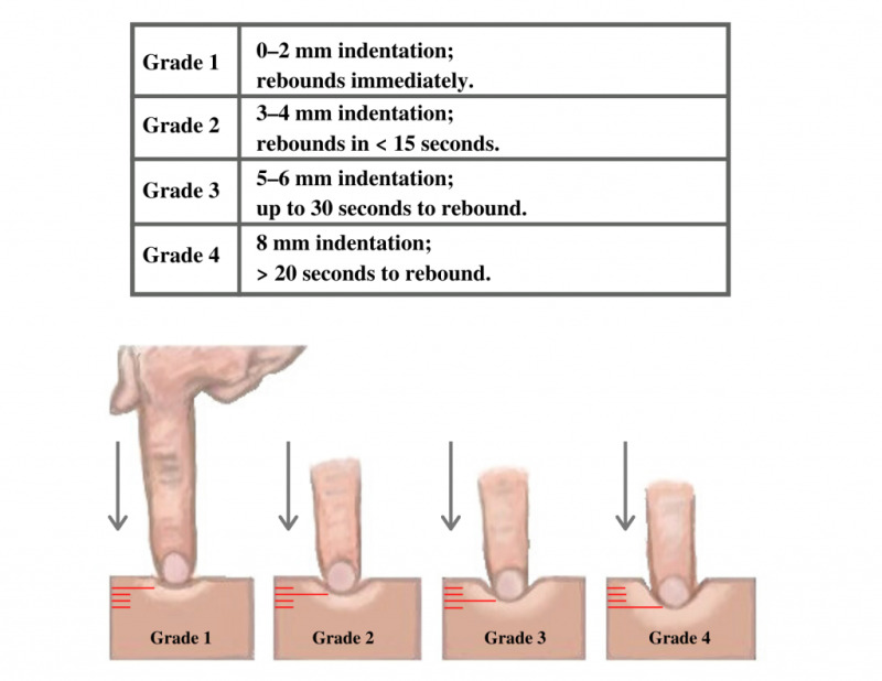 Aula 8 edema