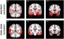 Fig. 19. Mean attribution maps obtained on demented patients.