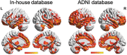 Fig. 22. Attribution maps (left, in-house database; right, ADNI database) generated by an attention mechanism module, indicating the discriminant power of various brain regions for Alzheimer’s disease diagnosis.