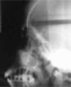 Figure 2. Cephalometric radiograph of a 15-year-old boy with thalassemia major disclosing prominent premaxilla, thickened frontal bone, thinned inferior border of the mandible and partially obliterated maxillary sinus.