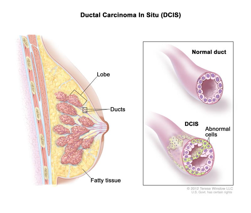 Breast Cancer Treatment During Pregnancy (PDQ®) - PDQ Cancer