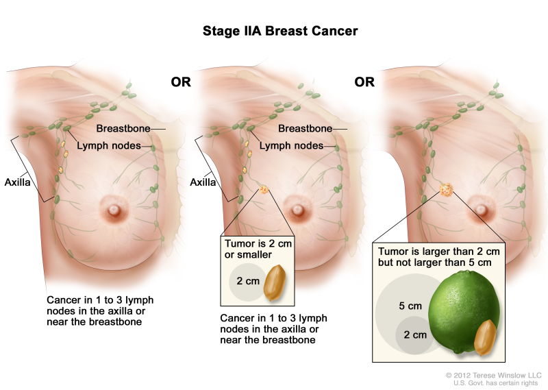 Breast Cancer Treatment During Pregnancy (PDQ®) - PDQ Cancer Information  Summaries - NCBI Bookshelf