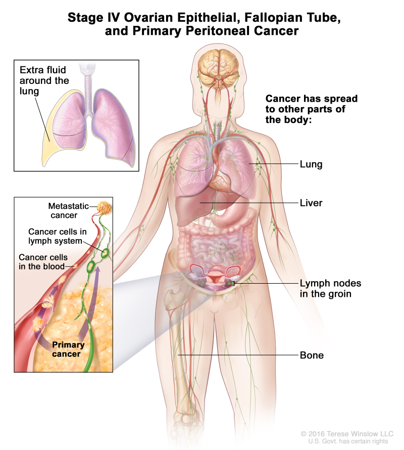 Figure In Stage Iv Cancer Has Pdq Cancer Information Summaries Ncbi Bookshelf 9693