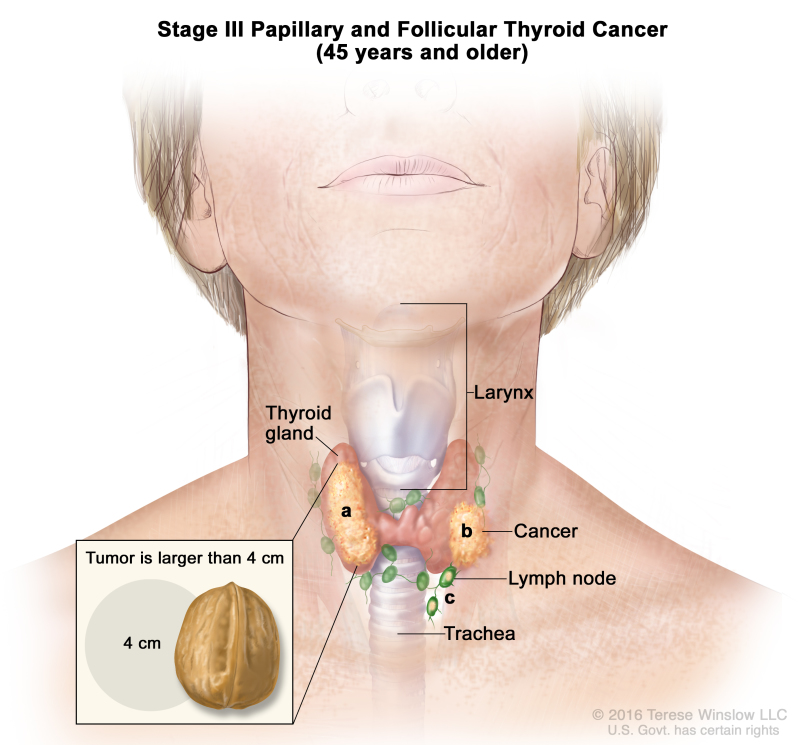 cancer swollen lymph nodes