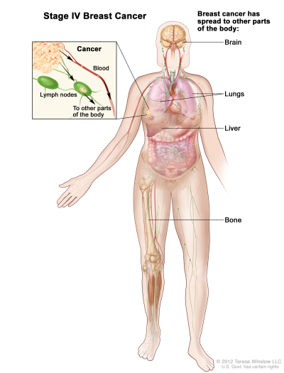 Table], Table 6. Anatomic Stage/Prognostic Groupsa,b - PDQ Cancer