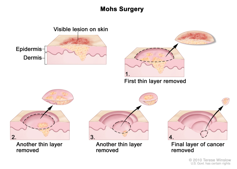 Mohs surgery; drawing shows a visible lesion on the skin. The pullout shows a block of skin with cancer in the epidermis (outer layer of the skin) and the dermis (inner layer of the skin). A visible lesion is shown on the skin’s surface. Four numbered blocks show the removal of thin layers of the skin one at a time until all the cancer is removed.