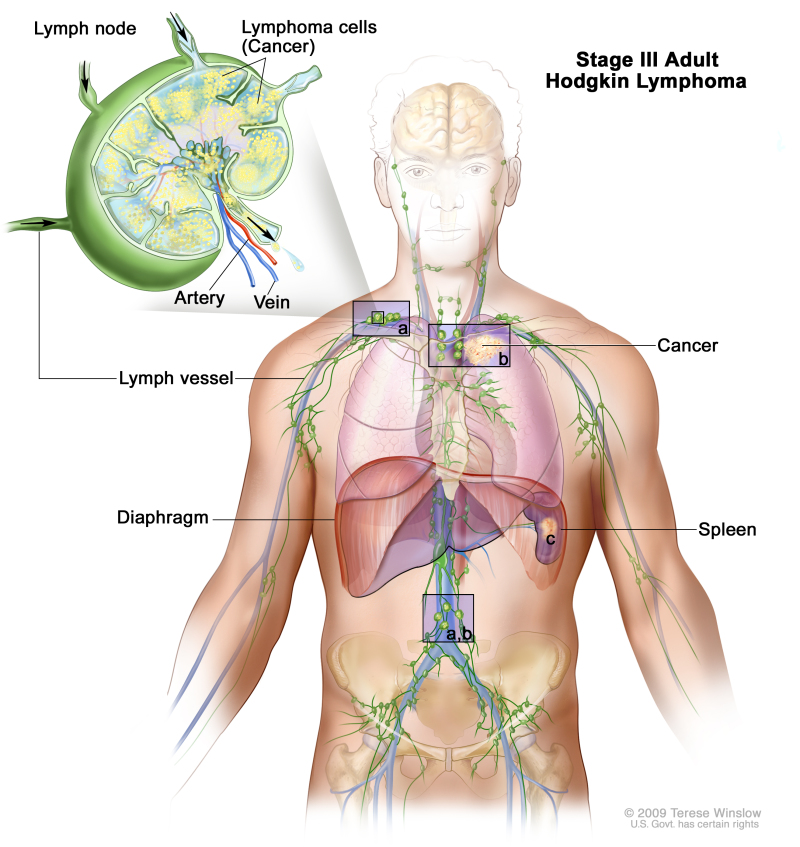 [Figure, Stage III adult Hodgkin lymphoma...] PDQ Cancer Information