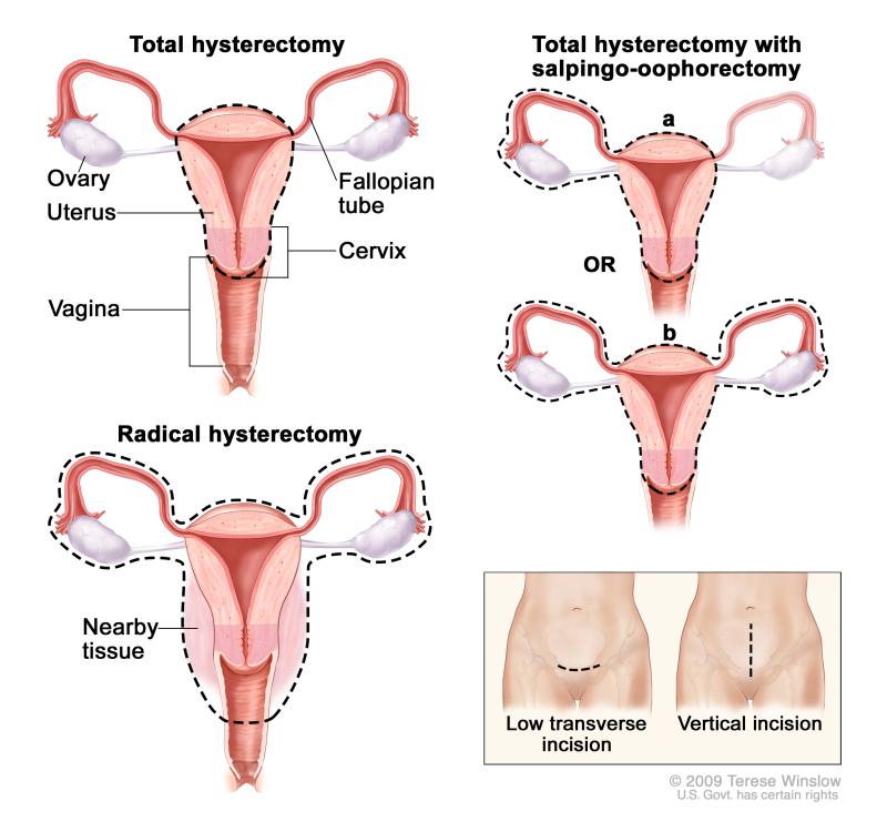 ovarian cancer tumor