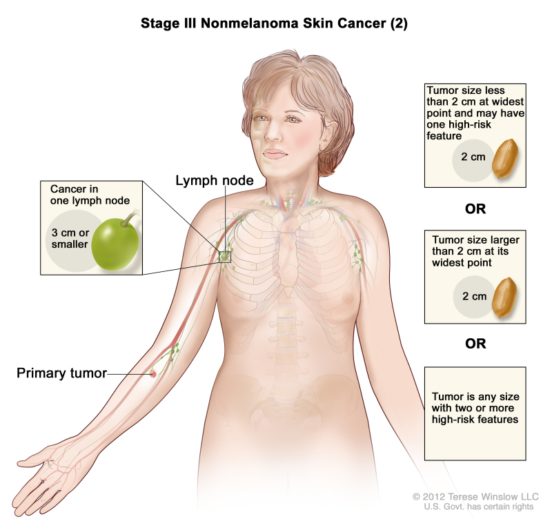 Skin Cancer Treatment Pdq Pdq Cancer Information Summaries Ncbi Bookshelf