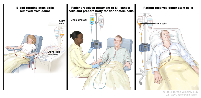 Adult Acute Lymphoblastic Leukemia Treatment (PDQ®) - PDQ Cancer