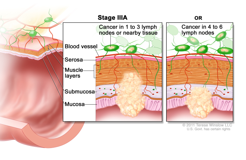 Colon Cancer Treatment (PDQ®) - PDQ Cancer Information Summaries - NCBI ...