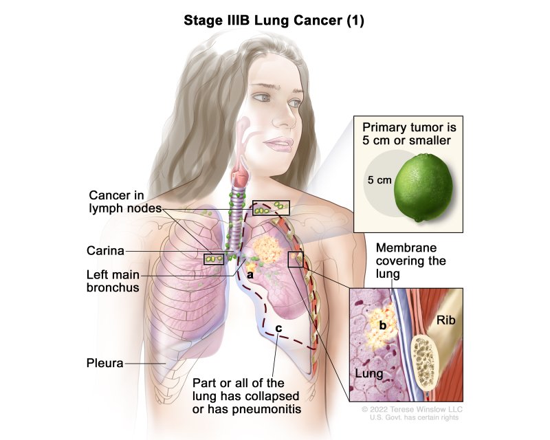 Understanding Lung Cancer Knight Cancer Institute Ohsu