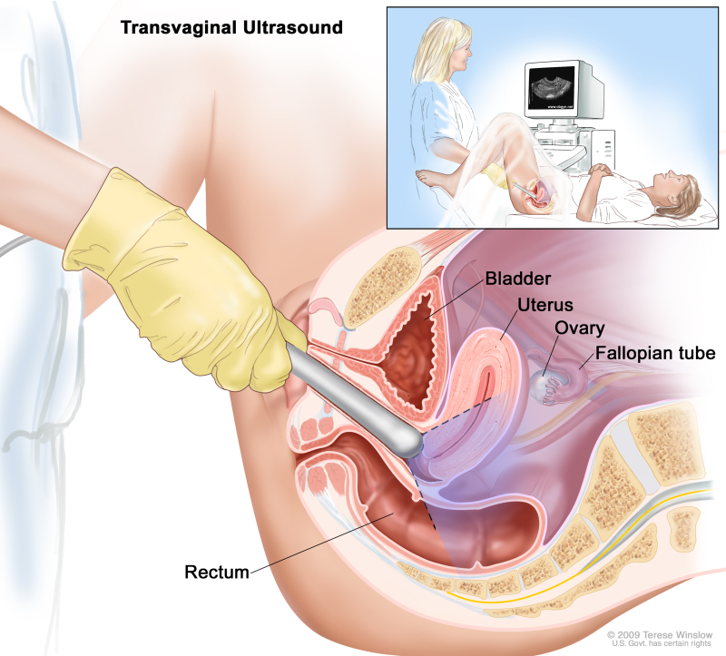 Radiation therapy for vaginal cancer in complete uterine prolapse