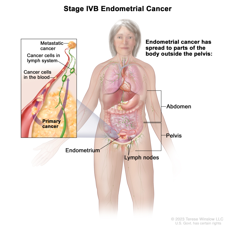 Closer Look at Postmenopausal Bleeding and Endometrial Cancer - NCI