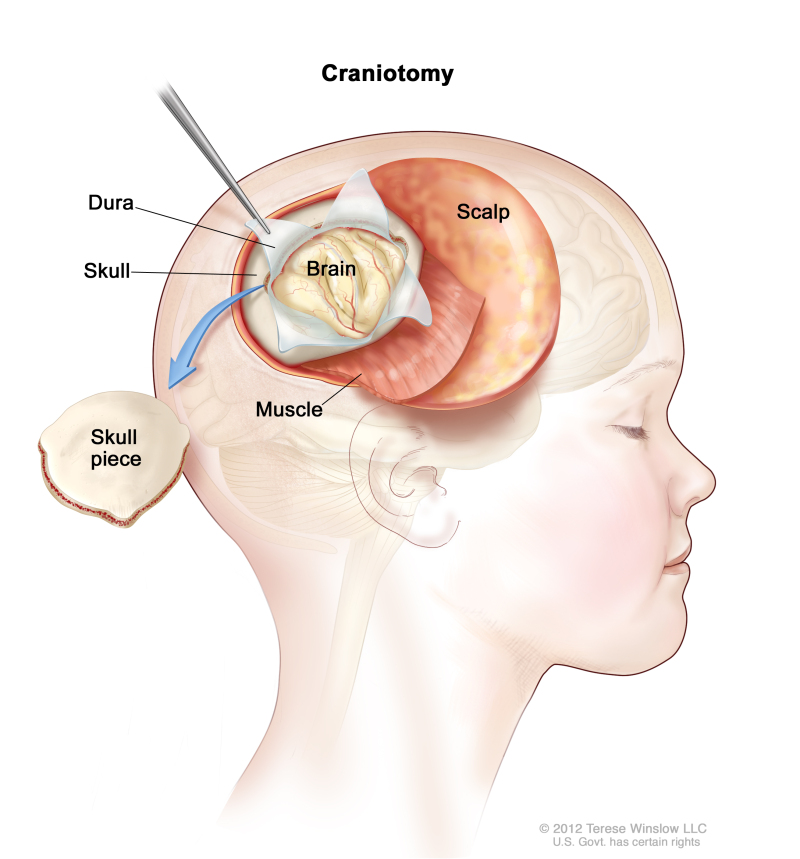 World Brain Tumor Day: What are brain and spinal cord tumor symptoms in  children? - Gigadocs - Online Appointment with Best Doctors