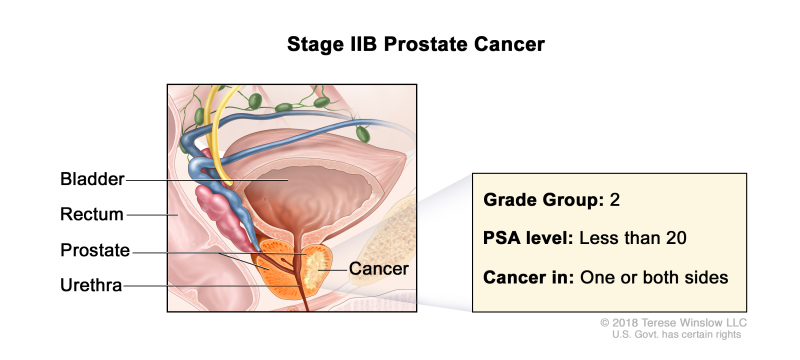 Stage IIB prostate cancer; drawing shows cancer in one side of the prostate. The PSA level is less than 20 and the Grade Group is 2. Also shown are the bladder, rectum, and urethra.