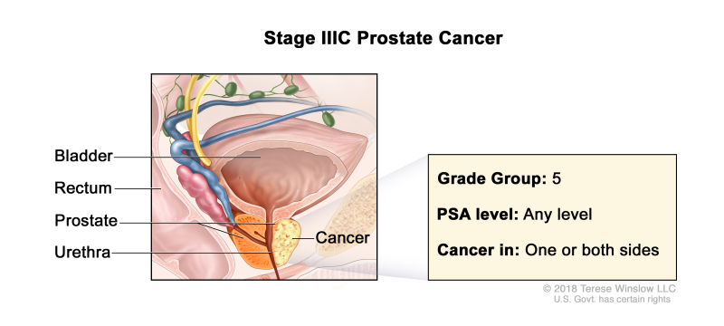 Stage IIIC prostate cancer; drawing shows cancer in one side of the prostate. The PSA can be any level and the Grade Group is 5. Also shown are the bladder, rectum, and urethra.