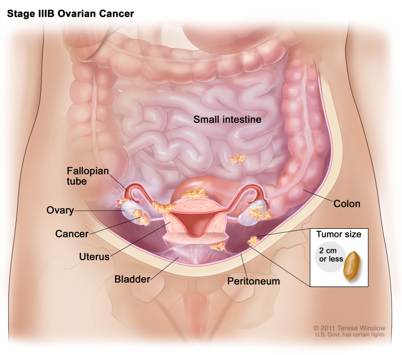 Figure, Anatomy of the female reproductive system.] - PDQ Cancer  Information Summaries - NCBI Bookshelf