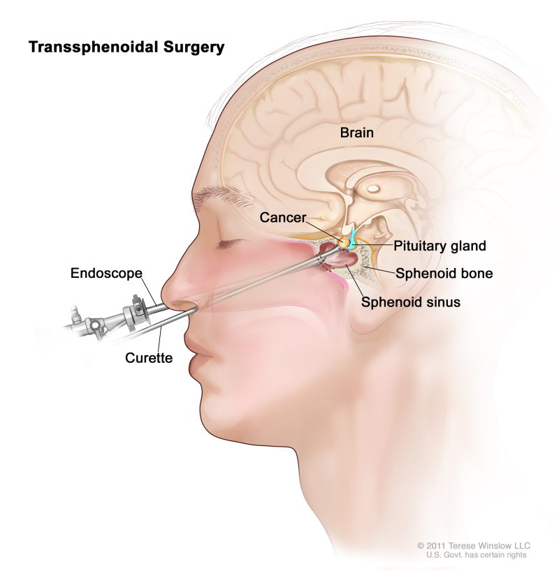 sphenoid sinus tumours