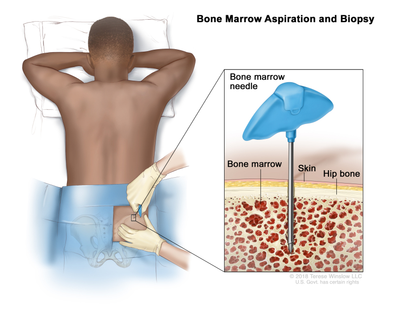 Bone marrow aspiration and biopsy; drawing shows a patient lying face down on a table and a bone marrow needle being inserted into the hip bone. An inset shows a close up of the needle being inserted through the skin and hip bone into the bone marrow.