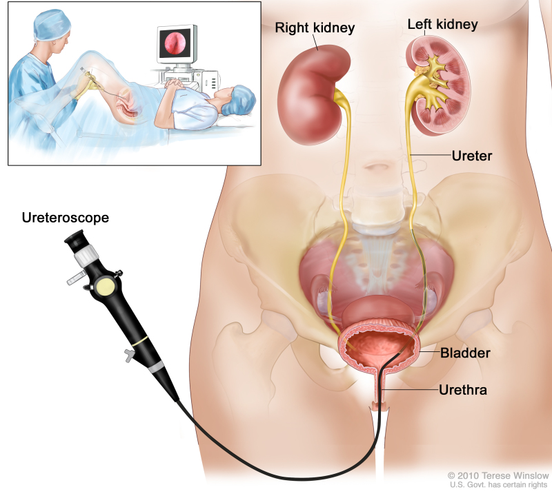 Figure, Anatomy of the female reproductive system.] - PDQ Cancer  Information Summaries - NCBI Bookshelf