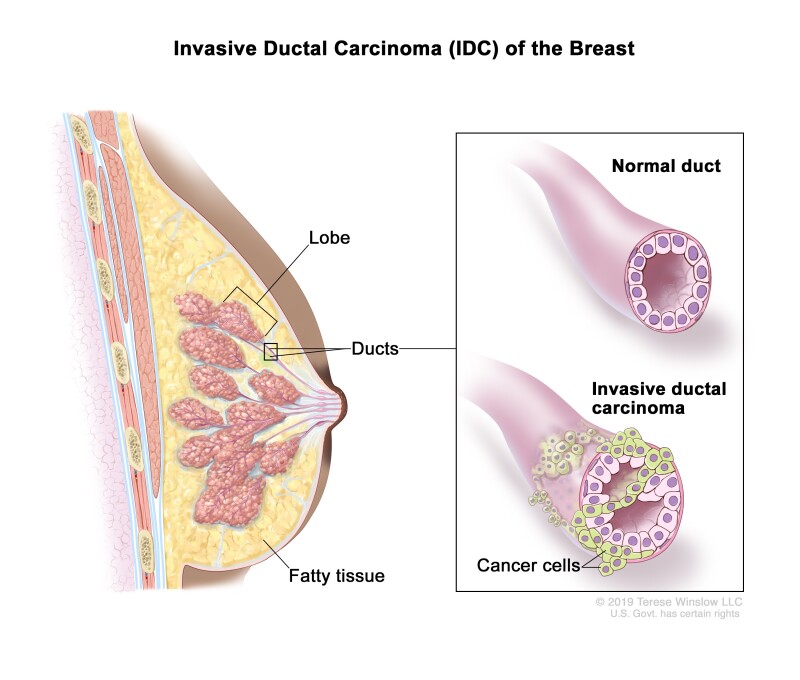 Figure Invasive Ductal Carcinoma Idc Of Pdq Cancer Information Summaries Ncbi Bookshelf