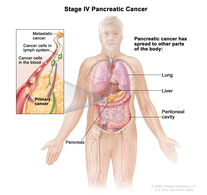 Figure Stage Iv Pancreatic Cancer The Pdq Cancer Information Summaries Ncbi Bookshelf 5279