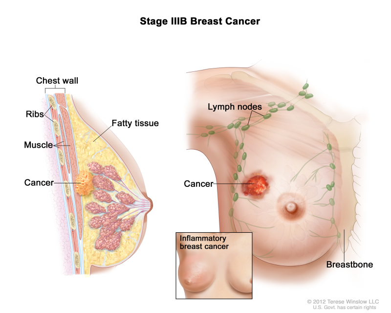 Cureus  Cutaneous Dermal Metastasis of Inflammatory Breast