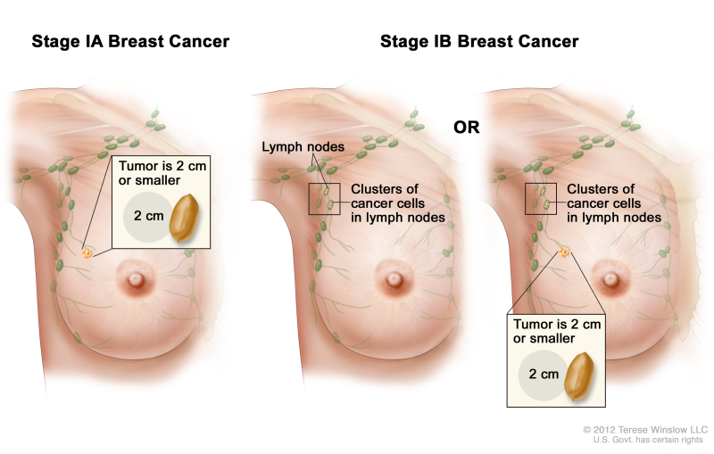 Breast Lumps – Know the basics  DG Laser & Cosmetic Gynecology Clinic