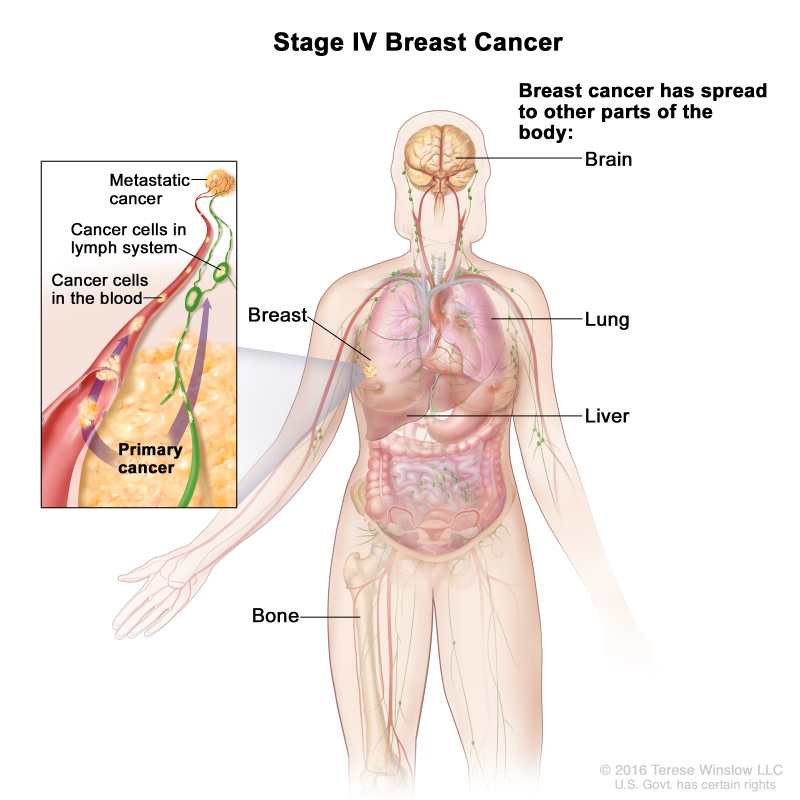 Figure Stage Iv Breast Cancer The Pdq Cancer Information Summaries Ncbi Bookshelf