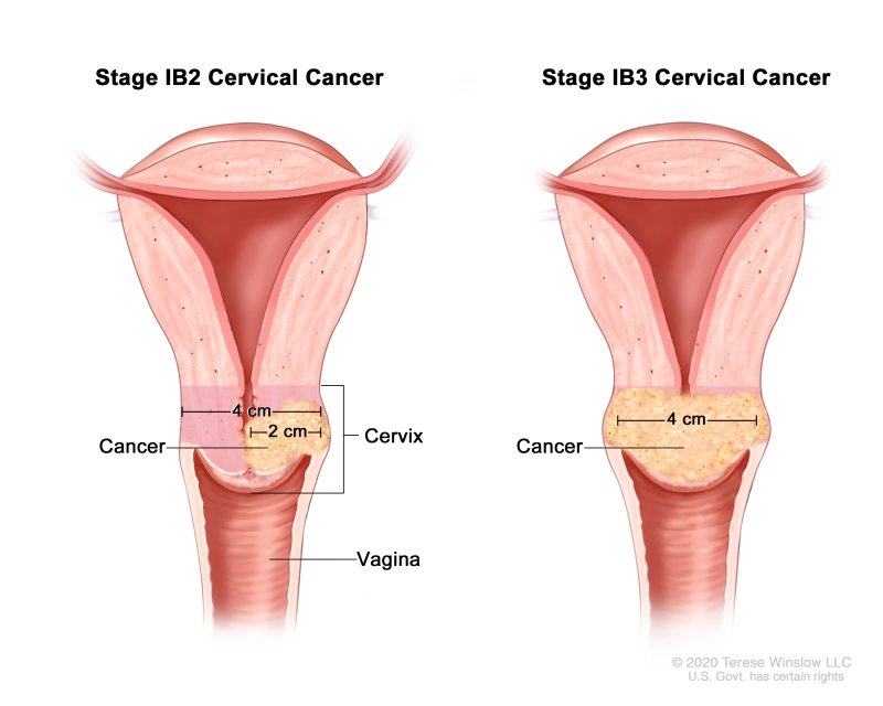 Cancer of the uterus overview - Cancer Council Victoria