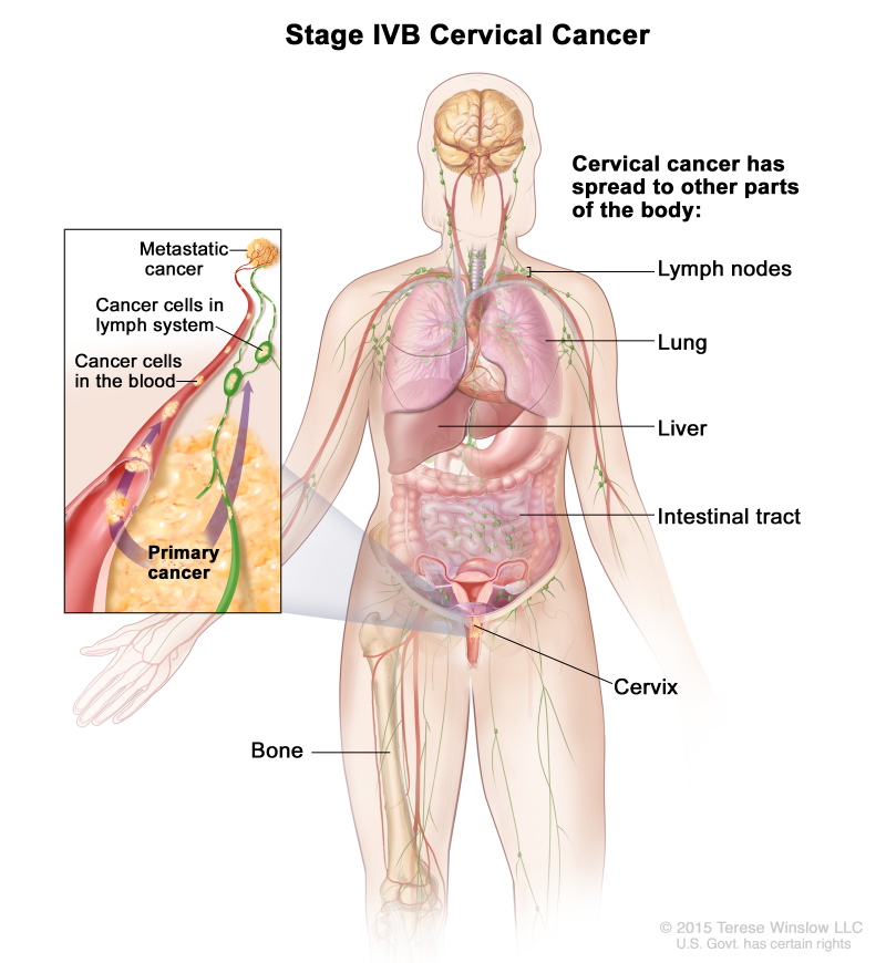 Figure, Anatomy of the female reproductive system.] - PDQ Cancer  Information Summaries - NCBI Bookshelf