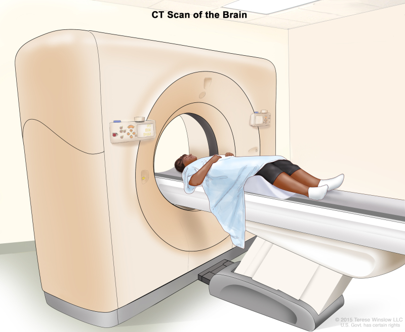 Adult Central Nervous System Tumors Treatment (PDQ®) - PDQ Cancer