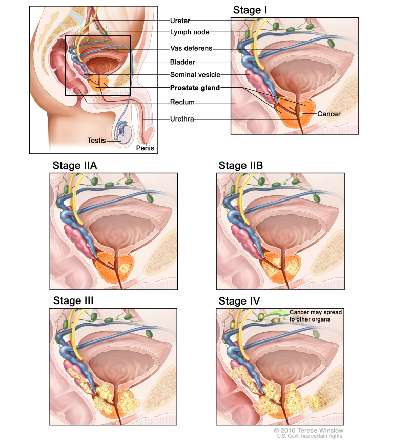 Prostate cancer staging; six panel drawing showing a side view of normal male anatomy and closeup views of Stage I, Stage IIA, Stage IIB, Stage III, and Stage IV showing cancer growing from within the prostate to nearby tissue and then to lymph nodes or other parts of the body.