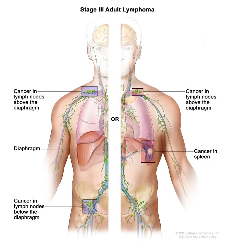 Adult Non Hodgkin Lymphoma Treatment Pdq Pdq Cancer Information Summaries Ncbi Bookshelf