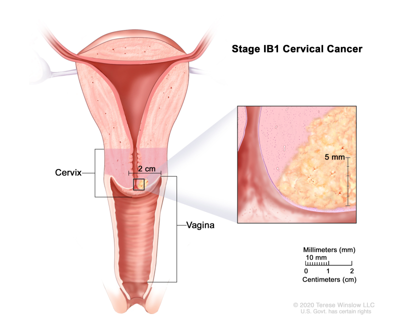 Cervical Cancer Treatment (PDQ®) - PDQ Cancer Information Summaries - NCBI  Bookshelf