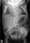 Figure 1. . Typical axial skeletal features in an infant with DLL3-related SCDO.