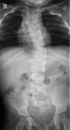 Figure 12. . Radiograph of a child with a mild form of DLL3-related SCDO.