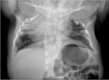 Figure 15. . Radiograph of an infant with MESP2-related STD.