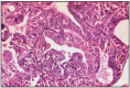 Fig. 11.1. Tubular adenocarcinoma, simple type.