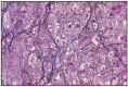 Fig. 11.13. Solid carcinoma, simple type.