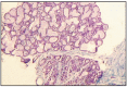 Fig. 11.29. Lobular hyperplasia, adenosis, simple type.