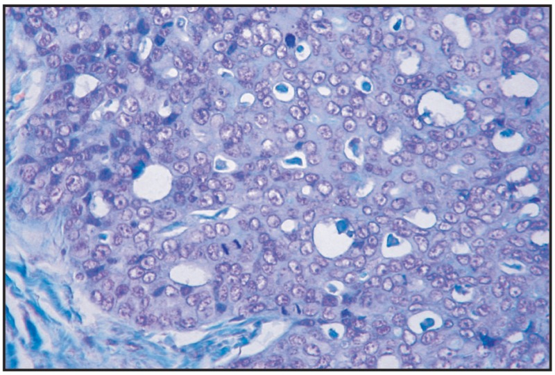 Fig. 11.6. Tubular adenocarcinoma, simple type.