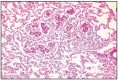 Fig. 16.13. Aortic body tumor, lung metastasis.