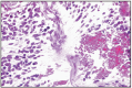 Fig. 16.16. Neuroblastoma.