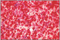 Fig. 16.19. Eosinophilic pituitary adenoma.