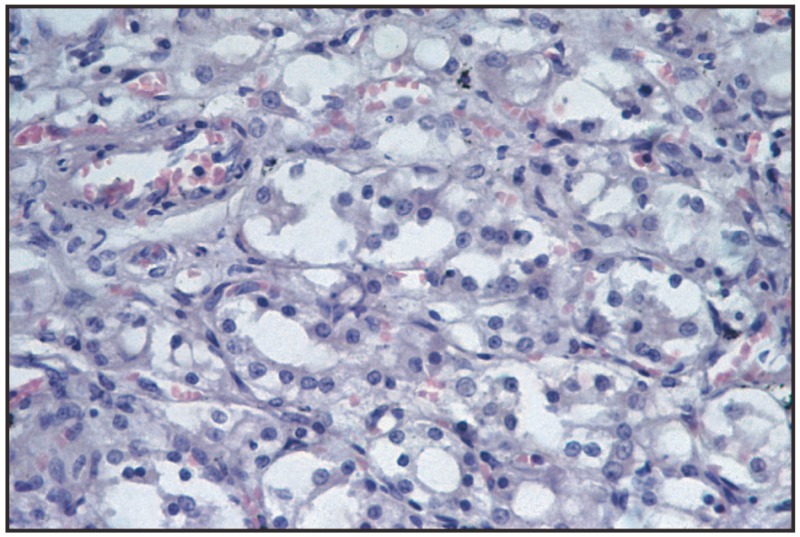 Fig. 16.2. Follicular carcinoma, thyroid gland.