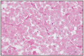 Fig. 16.23. Carcinoma, adrenal gland.