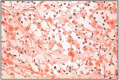 Fig. 16.7. “C” cells carcinoma.