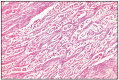 Fig. 16.9. Carotid body tumor.